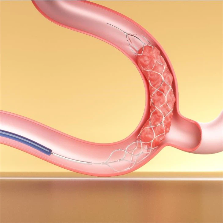 Stent Retrieval Device