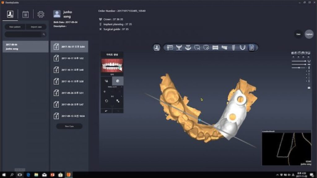 Dental Implant Planning Software