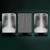 Dual Energy Subtraction