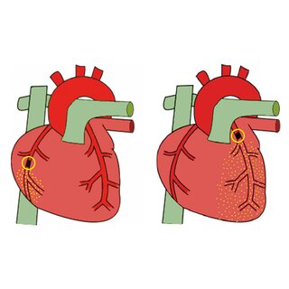 Culprit Coronary Artery Algorithm system