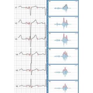Non-invasive diagnosis of ischaemic heart disease